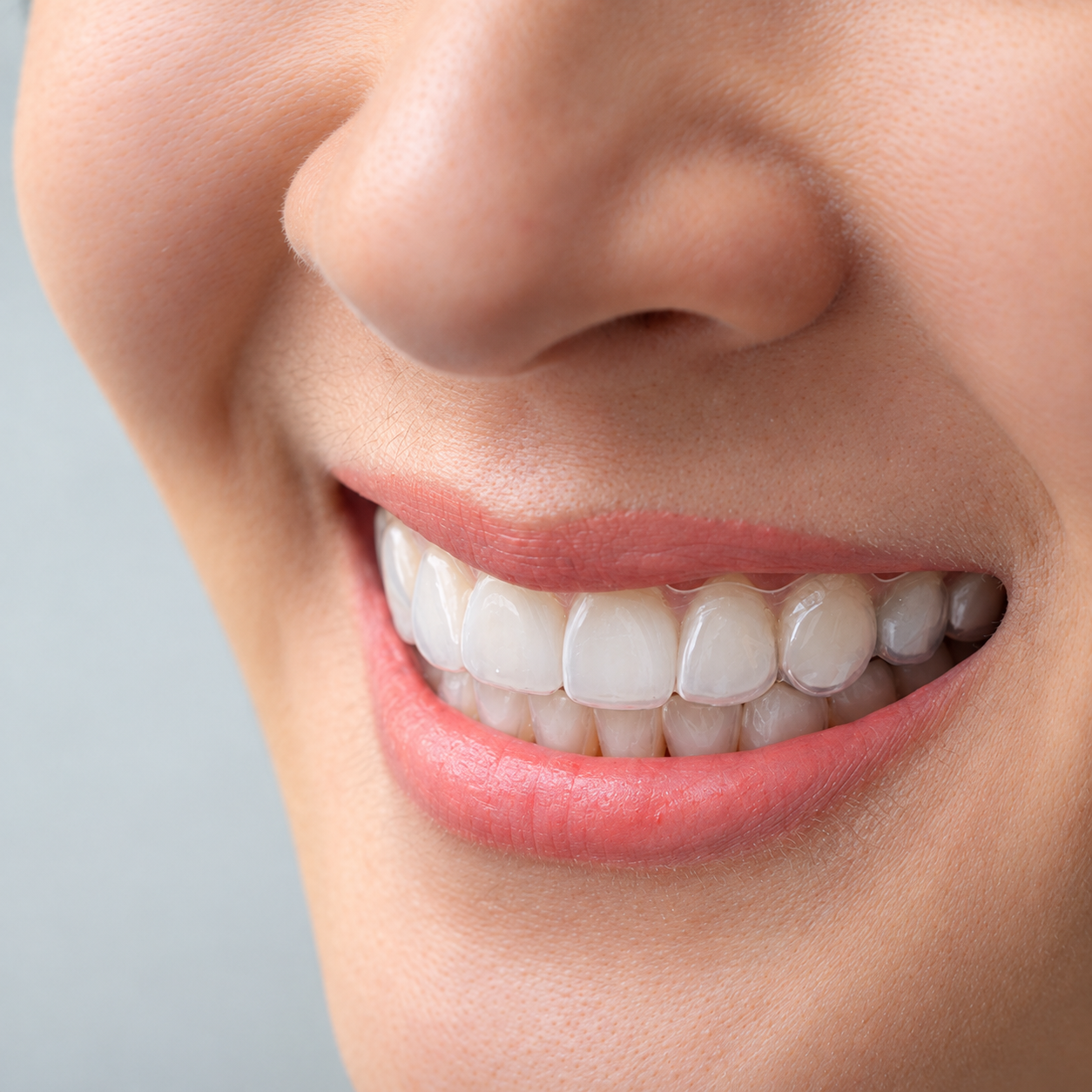 Clear Aligners process